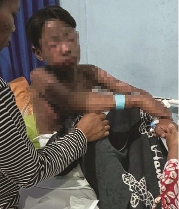 Bocah 14 Tahun Alami Toksik Epidermal Nekrolosis