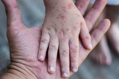 Cegah Penularan Mpox, Masifkan Sosialisasi PHBS ke Masyarakat